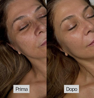 Immagine prima-dopo trattamento viso coreano 2